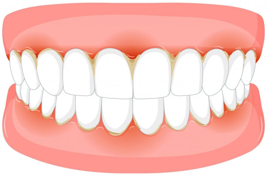 Лечение пульпита и периодонтита: как сохранить зуб